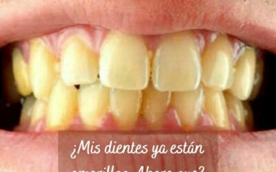 ¿Mis dientes ya están amarillos, ahora qué?